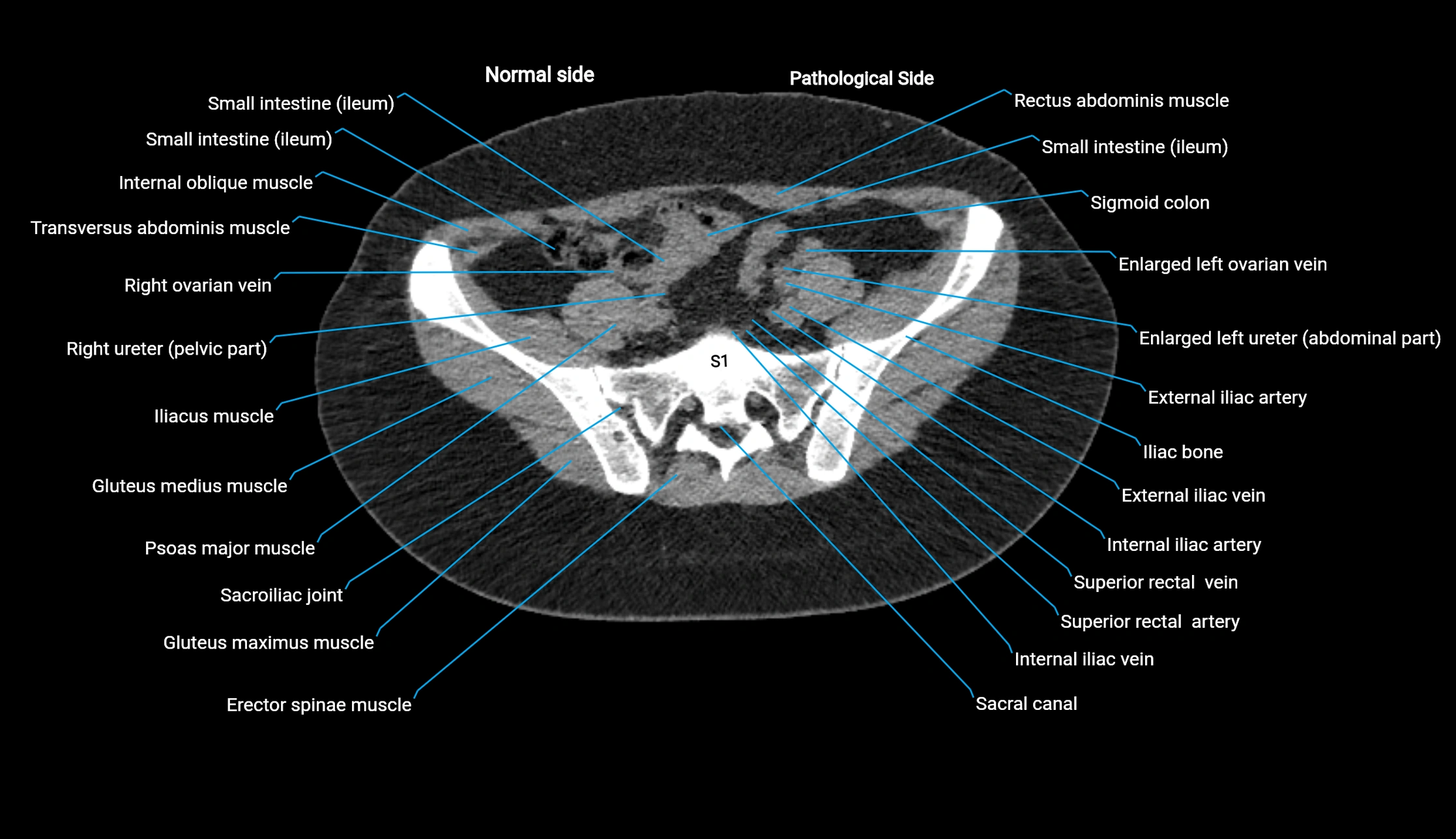 CT KUB axial cross sectional anatomy  radiology image -img-00201-00118.webp